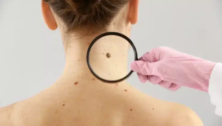 Skin Cancer