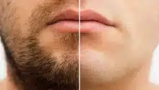 Hair Removal