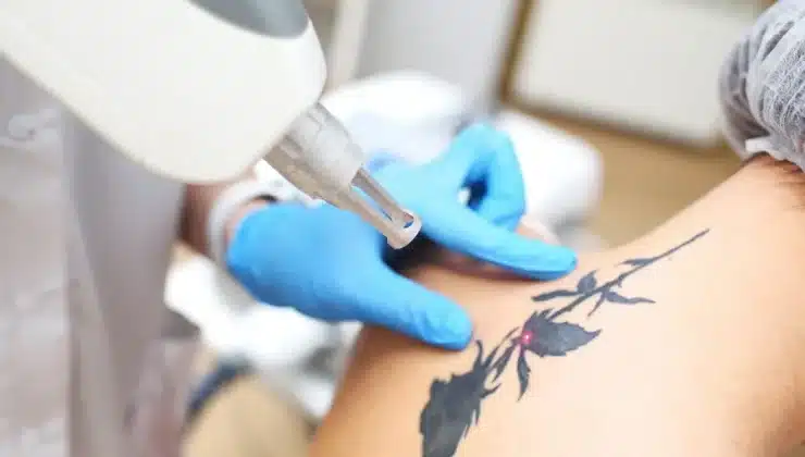 Tattoo Removal
